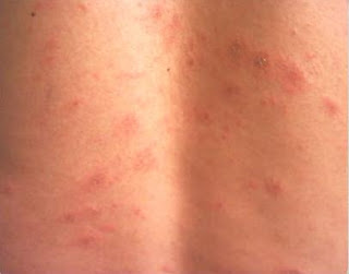 De todo un poco: Pitiriasis Rosada