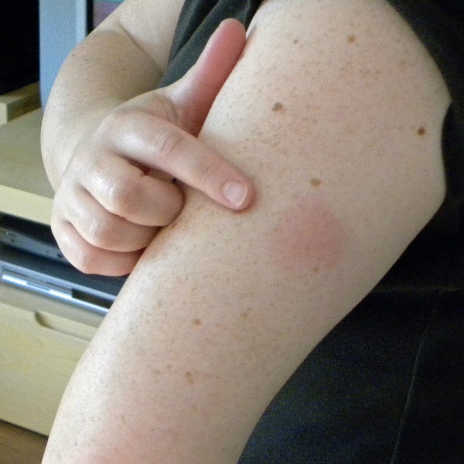 red marks on arm