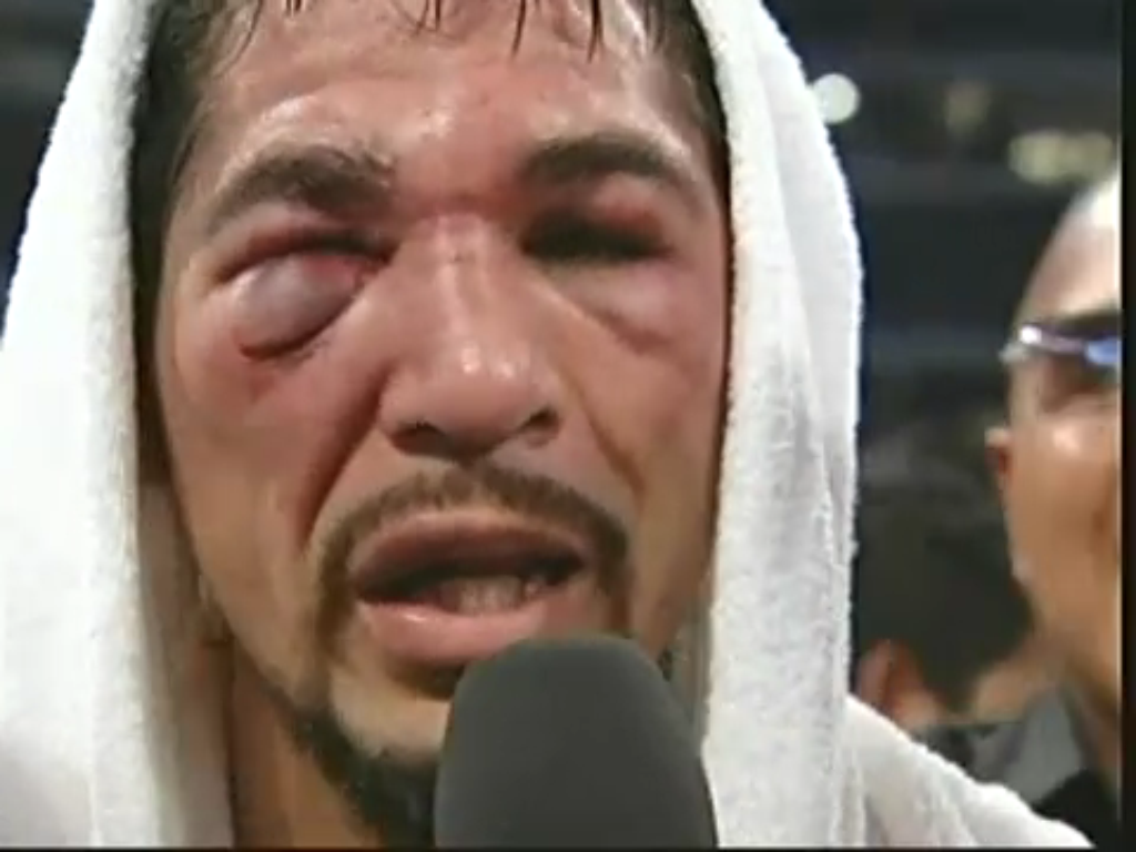 Margarito%2BFace%2BAfter%2BPacquiao%2BFight%2BPictures%2B2.png