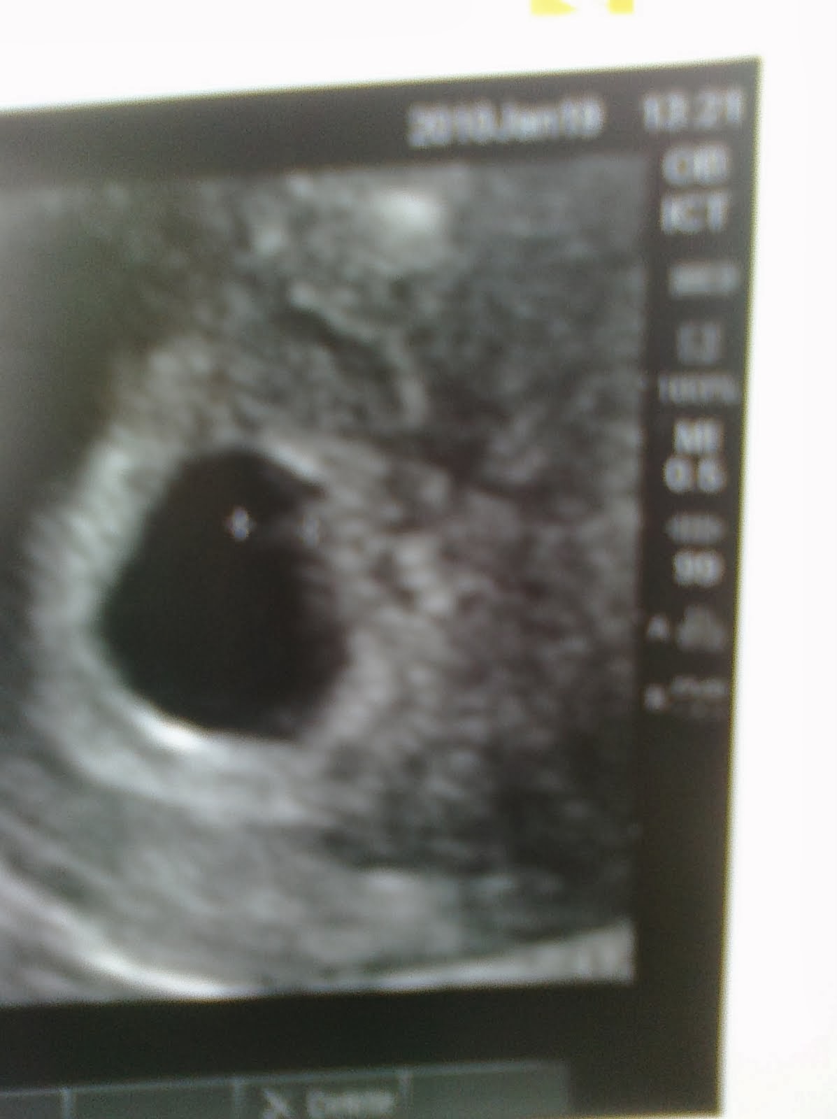 [ultrasound+6+weeks+1-19-2010++-2.JPG]