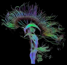 DTI (TRACTOGRAPHY)