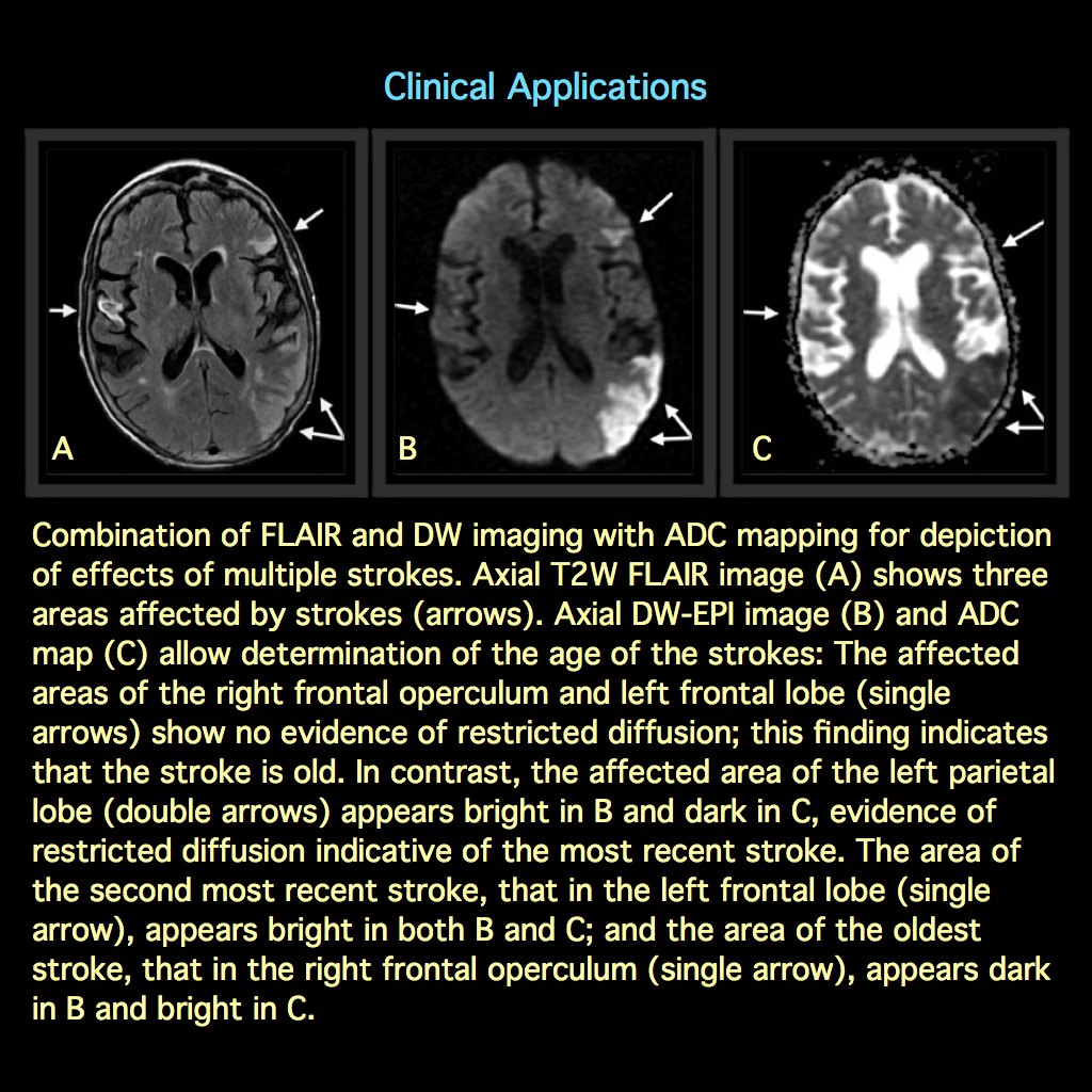 MRI BLOG Diffusion weighted MR Imaging mri-blog-diffusion-weighted-mr-imaging