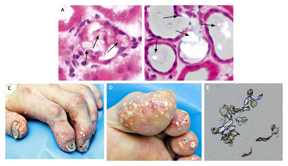 Doctors Gates Renal Failure from Vitamin C after Transplantation