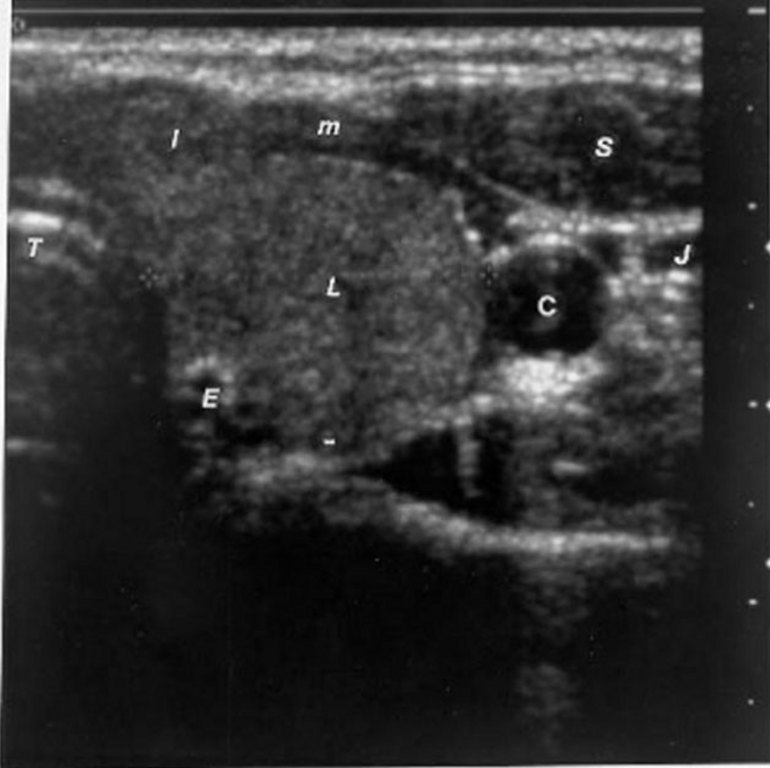Thyroid ultrasound template - NeilMccarthy6's blog