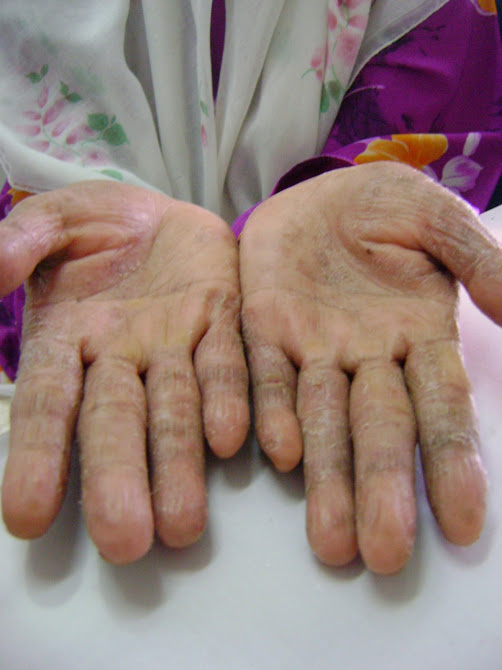 DALAM RAWATAN (ECZEMA/PSORIASIS)