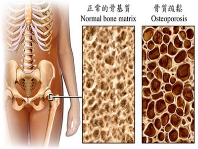 [Osteoporosis.jpg]