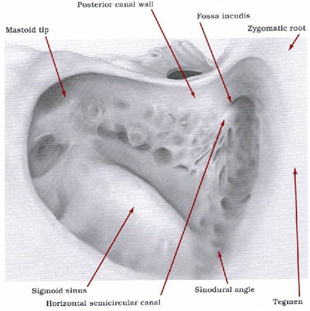 MEDICAL IMAGES Canal Wall Down Procedure
