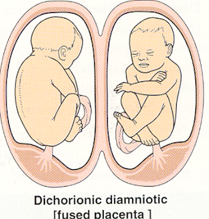 dichorionic diamniotic twins
