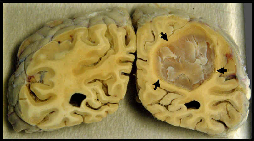 malignant brain tumors?