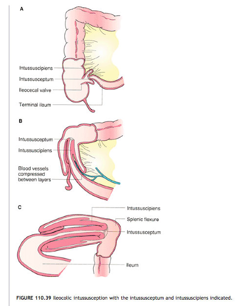 Intussusception Adult 116