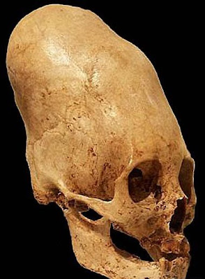 PICS DOT COM: Deformation of the Human Skull