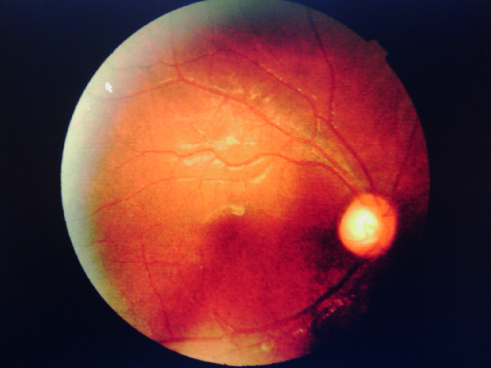 Journey Of A Medie On The Retinal Changes
