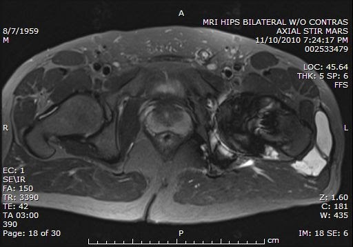 Hamid s Radiology Blog Metallosis And Pseudotumor Of The Hip After hamid-s-radiology-blog-metallosis-and-pseudotumor-of-the-hip-after