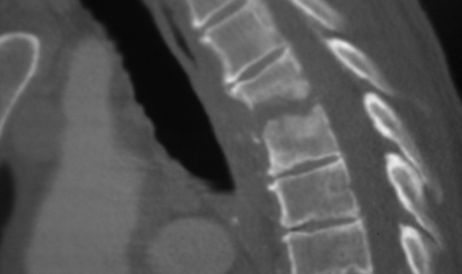 Daily Dose: discitis