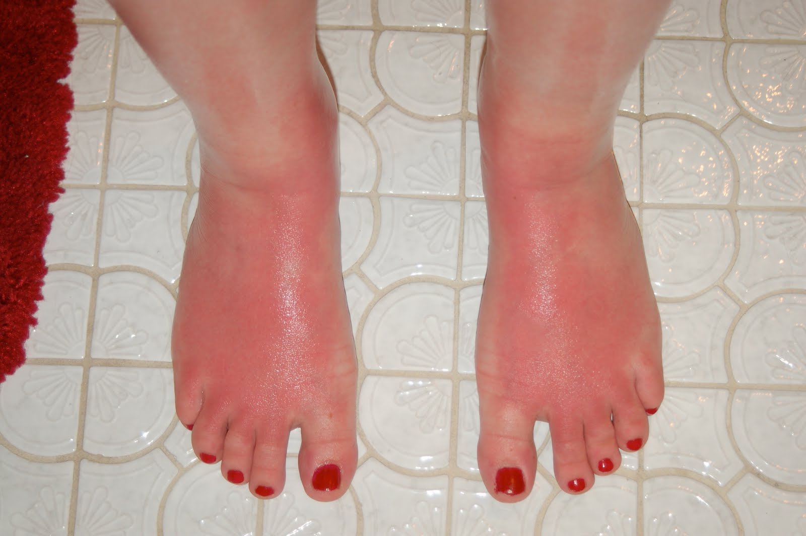PODIATRIST DISCUSSES TREATMENT OF SUNBURN ON THE FEET PODIATRIST