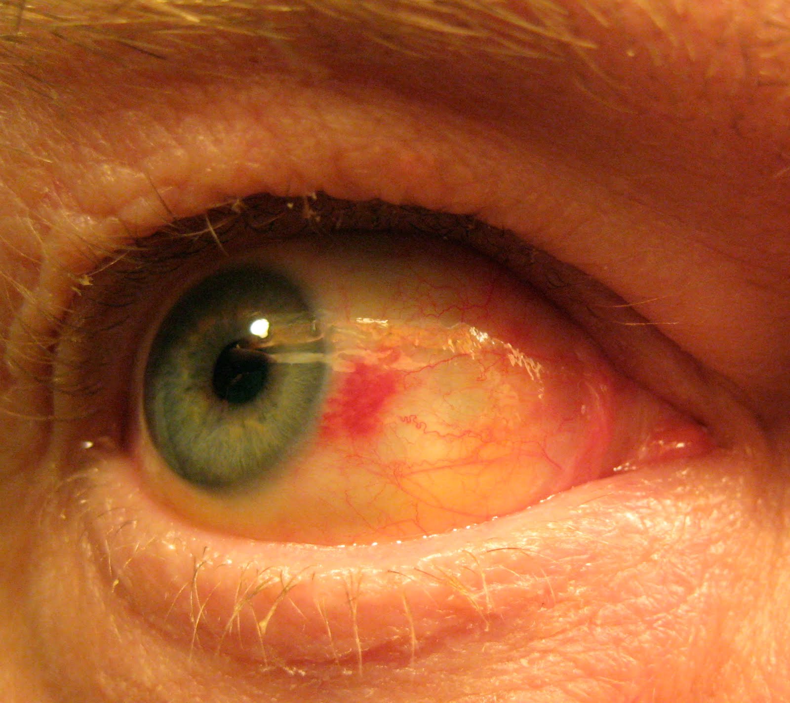 Random Walks Subconjunctival Hemorrhage