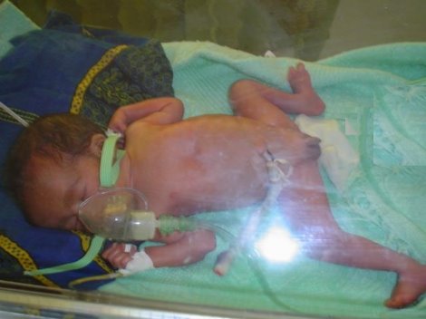 [premature_baby_africa_hospital.jpg]