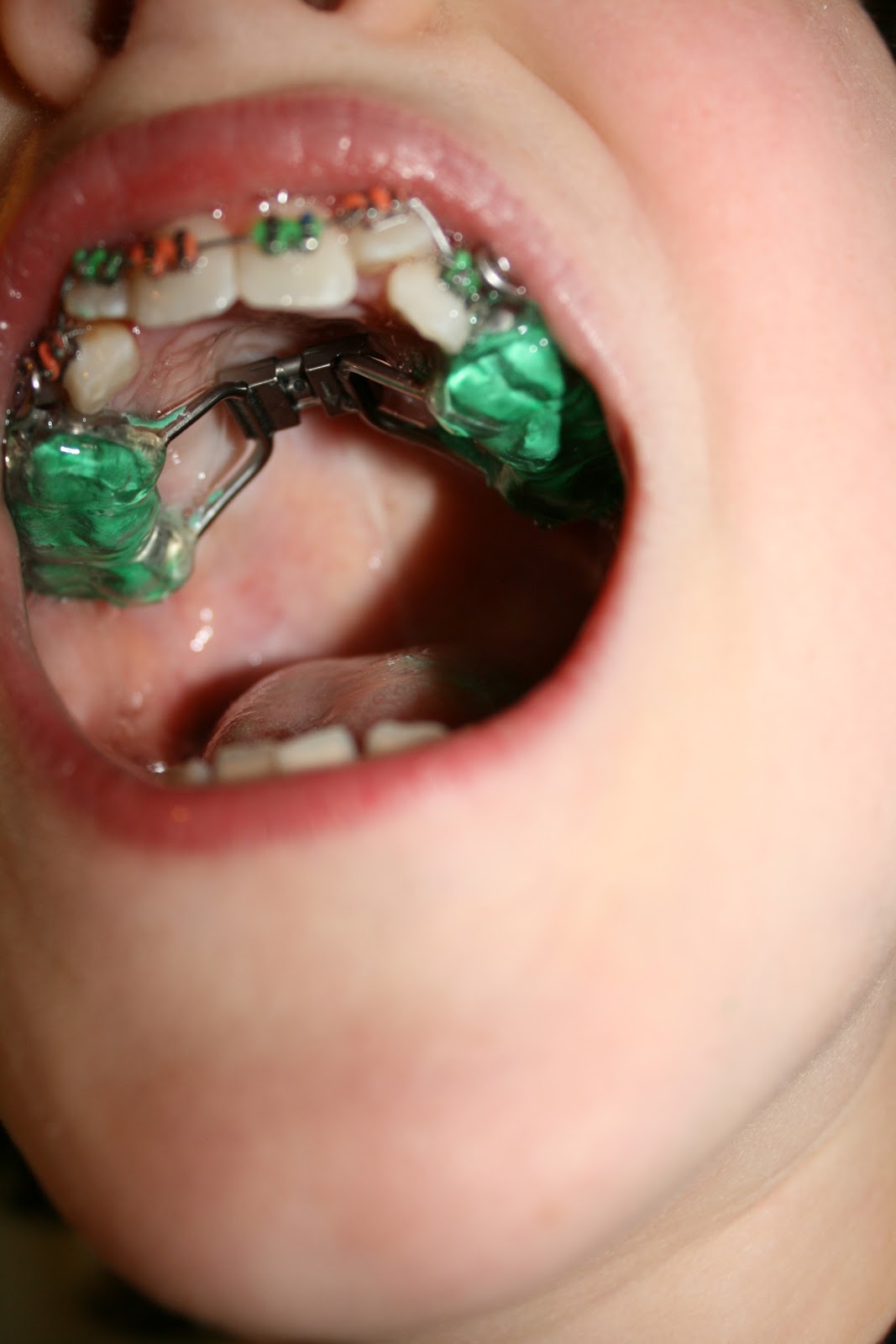 A Day in the Life Brace Face (Phase One)