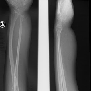 Medicine Blogging: LEFT RADIUS ULNA RADIOGRAPH