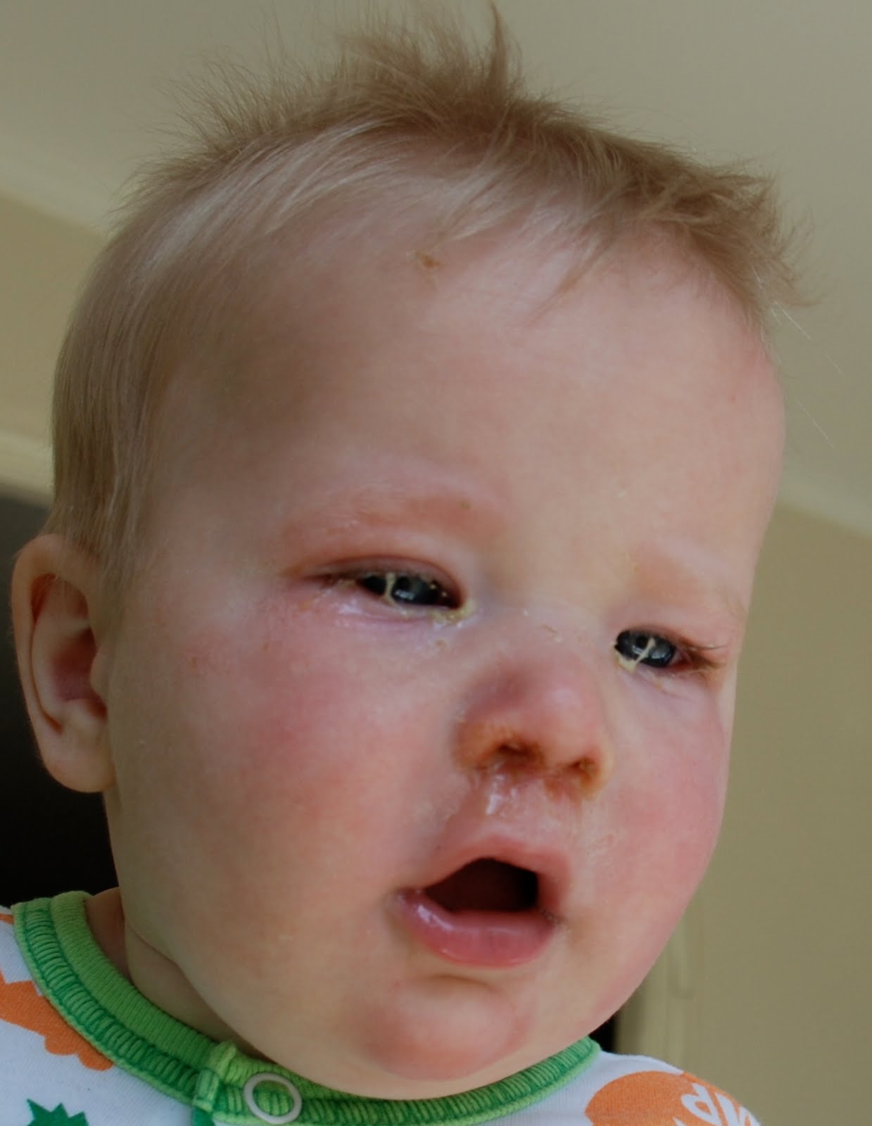 Pinkeye (Conjunctivitis) in Pictures: Types, Treatments ...