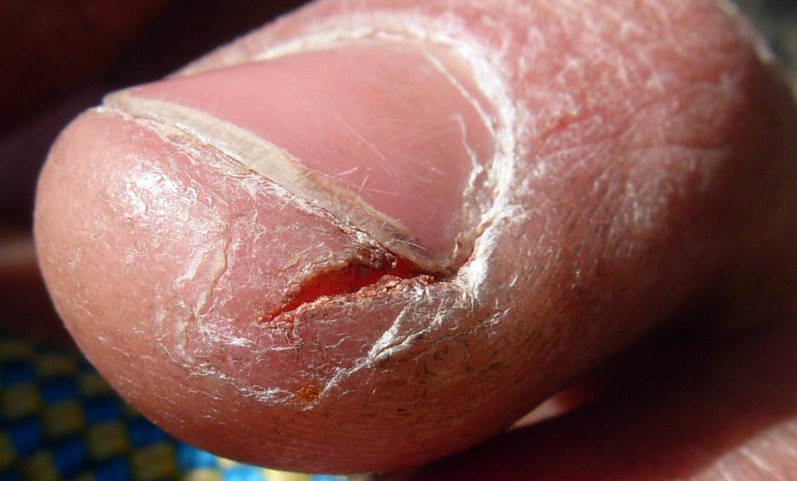 Dry skin between fingers? | Yahoo Answers