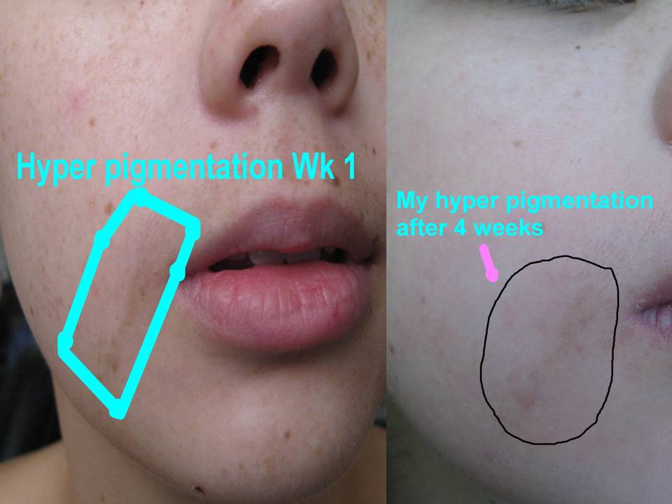 obagi nu derm week 4
