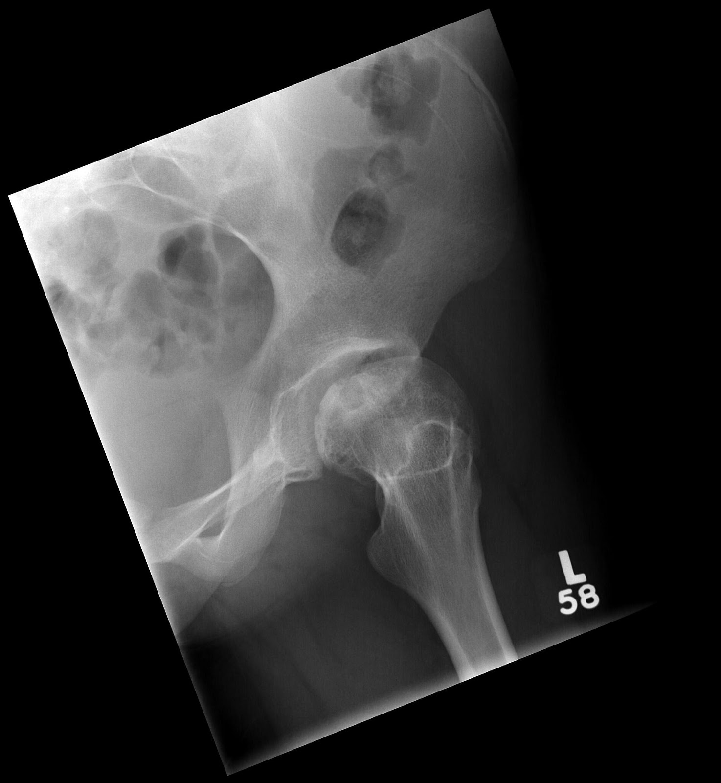 Post Gad: bone infarction (SLE)