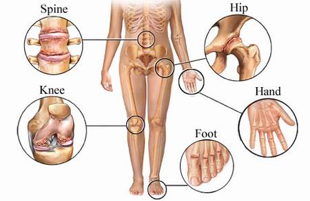 osteoscleroza articulației umărului decât a trata