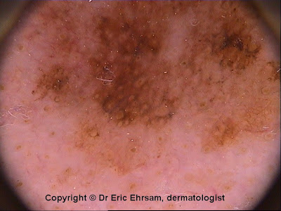 Pdf melanoma of the penis