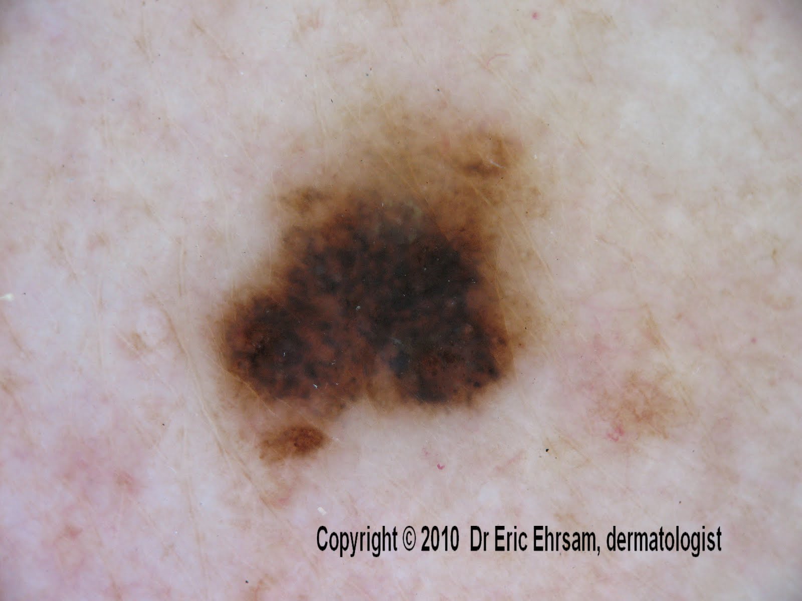 Skin Color Recktangular Shape dermoscopy: July 2010