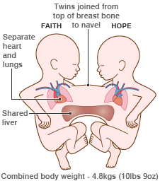 [williams+conjoined+diagram.gif]