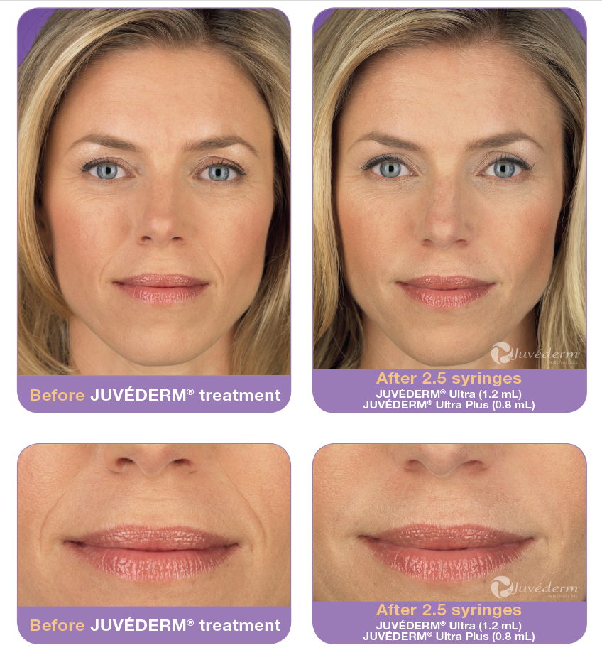 hyaluronic acid injections face