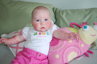 Elizabeth Menges: Gianotti Crosti Syndrome