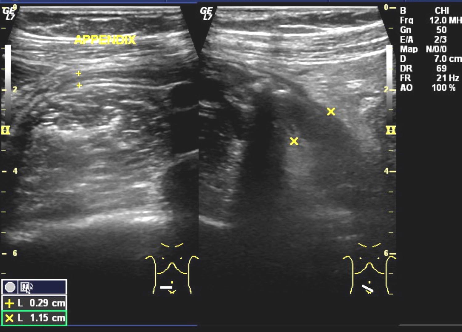 MY ERADIOLOGY CASES March 2010