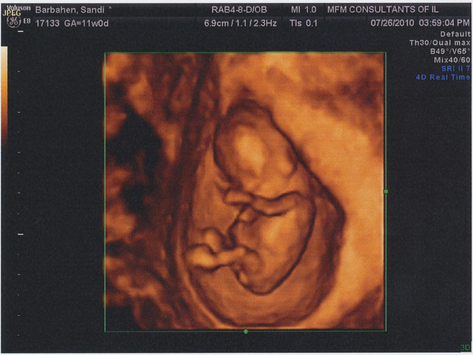 Pregnancy: weeks 10-11