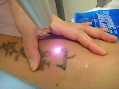 Laser Tattoo Removal - How Effective Will it Be?