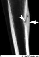 Logan :): Broken Bones