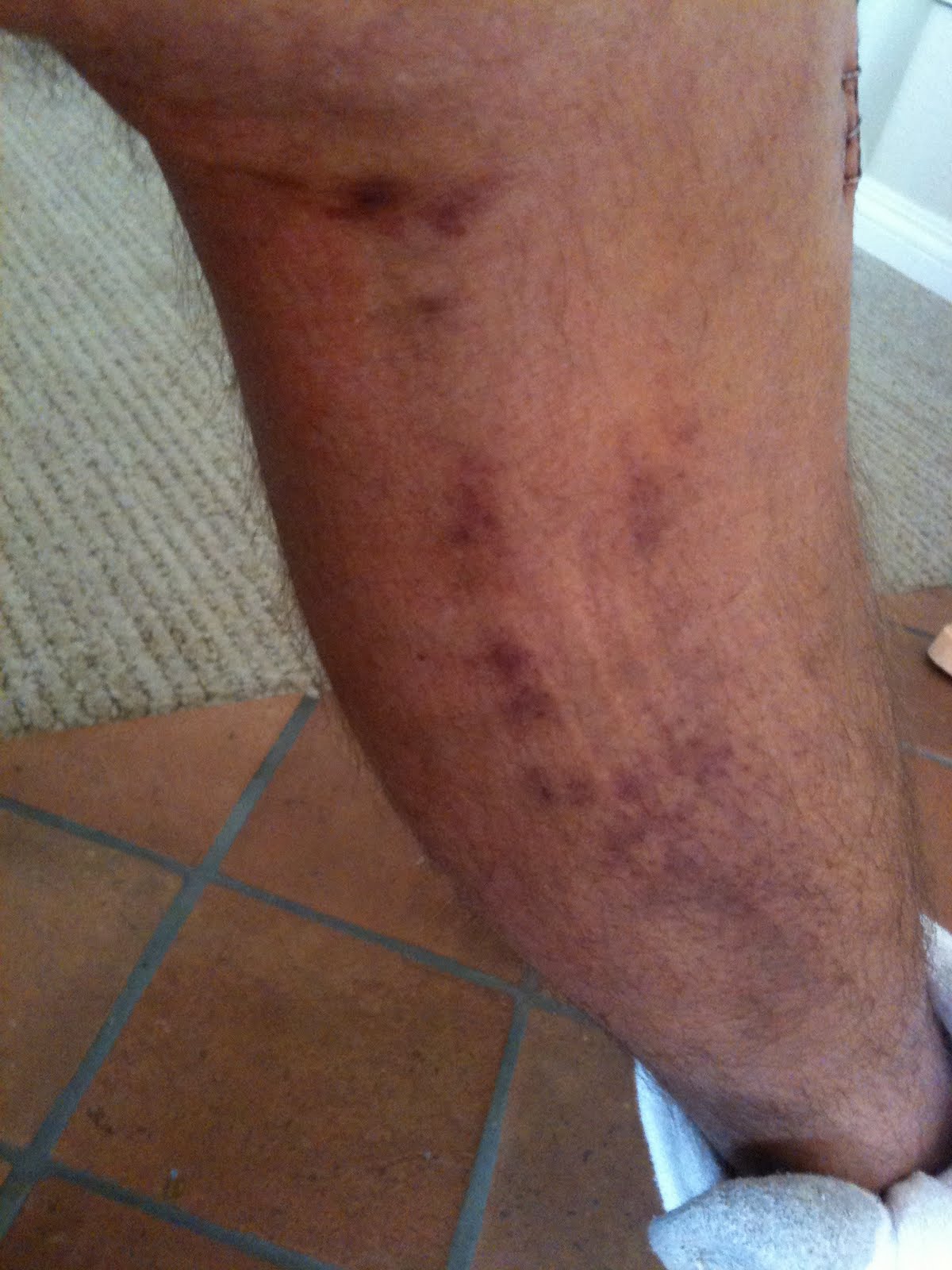 A Diary of a Wimpy Dad PostOp Day 5 The Ugly Knee is feeling better
