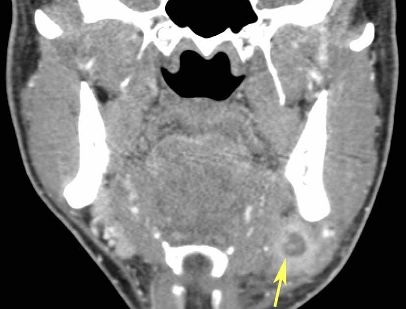 Rit Radiology Submandibular Sialadenitis With Abscess