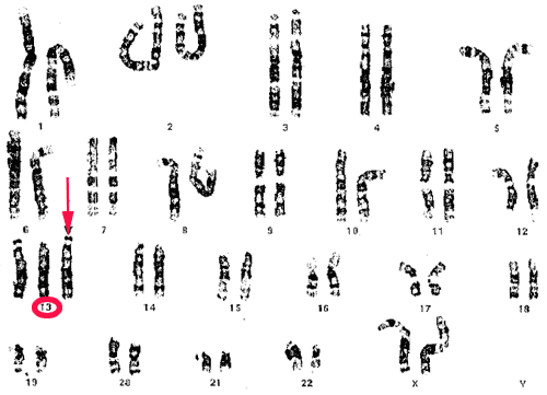 Deformed sperm birth defects