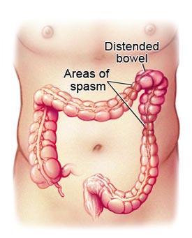 colon irritabile prostatite cronica