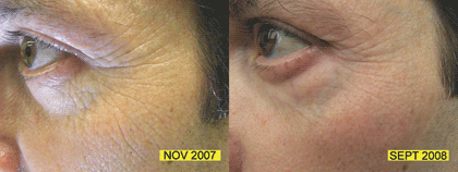 [Red-LEDs-Reduce-Wrinkles-Anti-Aging.gif]