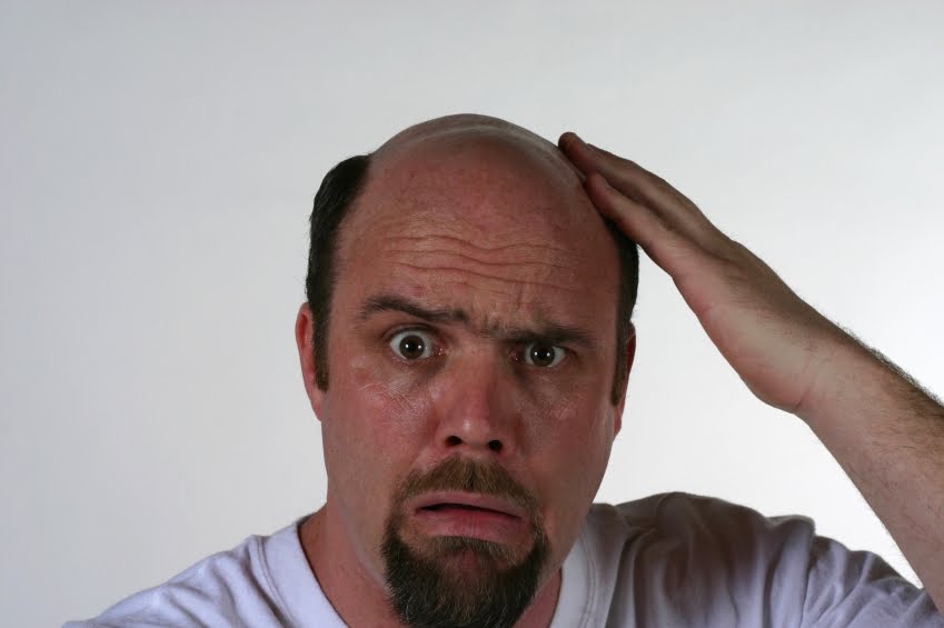 Welcome To Info Terkini What Causes Baldnesshair Loss