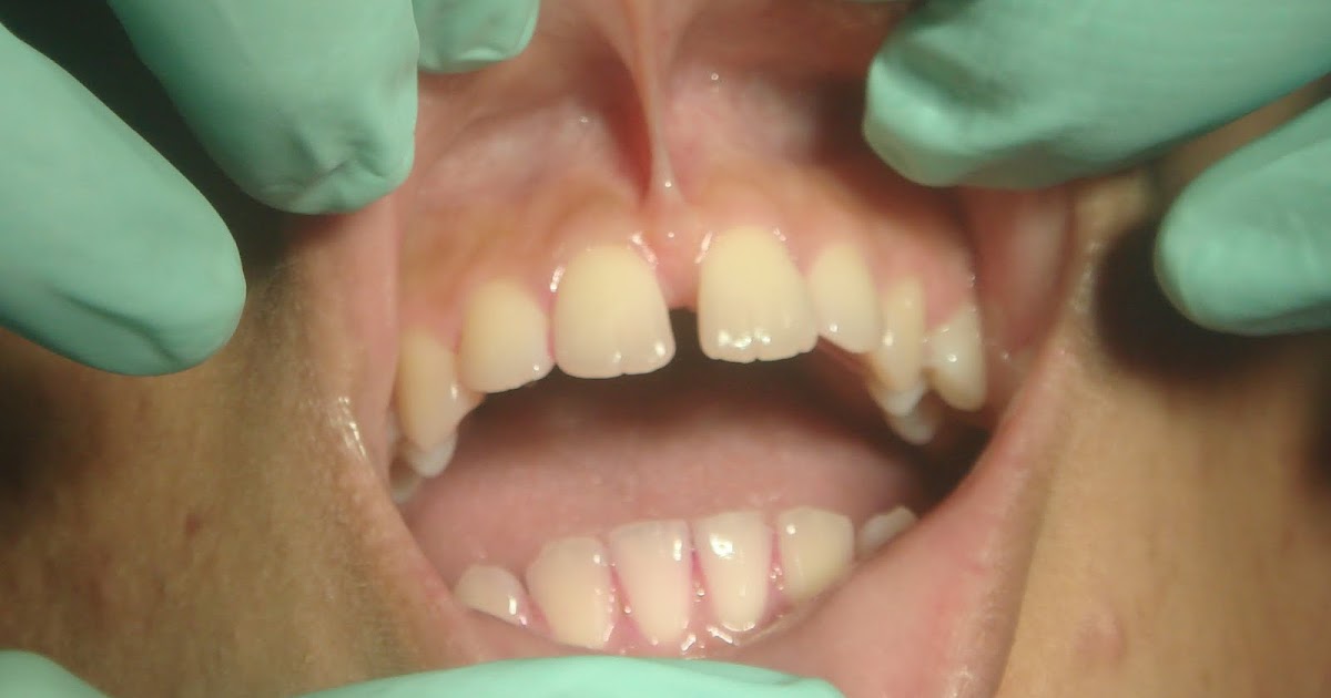 Case Report Cosmetic Esthetic Dentistry With Frenectomy And Veneer