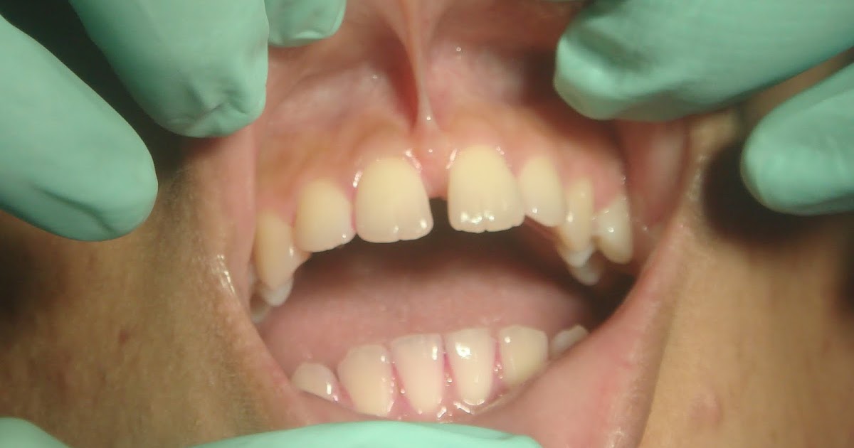 Case Report CosmeticEsthetic Dentistry with Frenectomy and Veneer