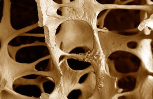 [osteoporosis.jpg]