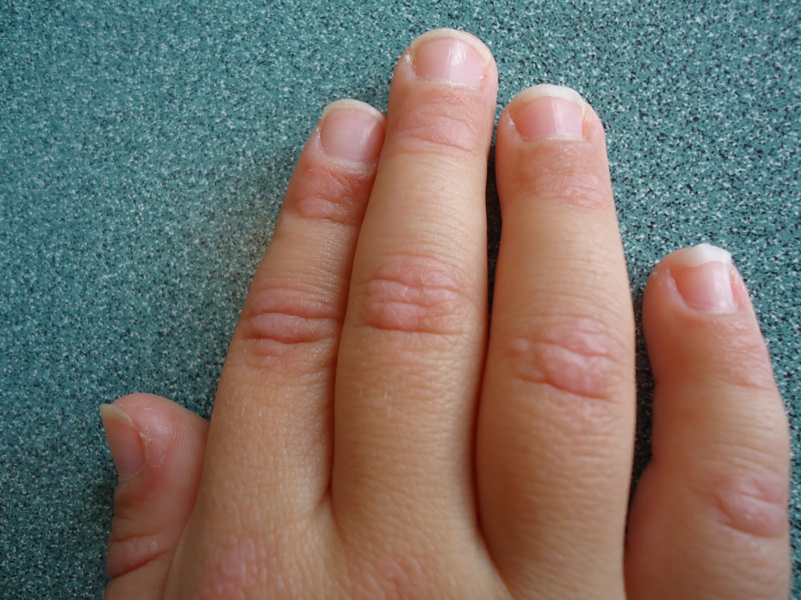 Itchy Bumps On Fingers In Winter
