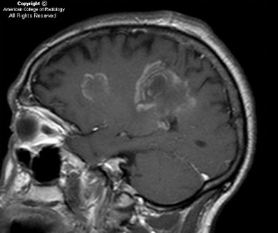Neuroradiology On the Net: Balo's concentric sclerosis