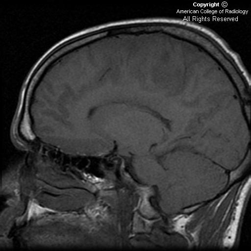 Neuroradiology On the Net Gliomatosis cerebri