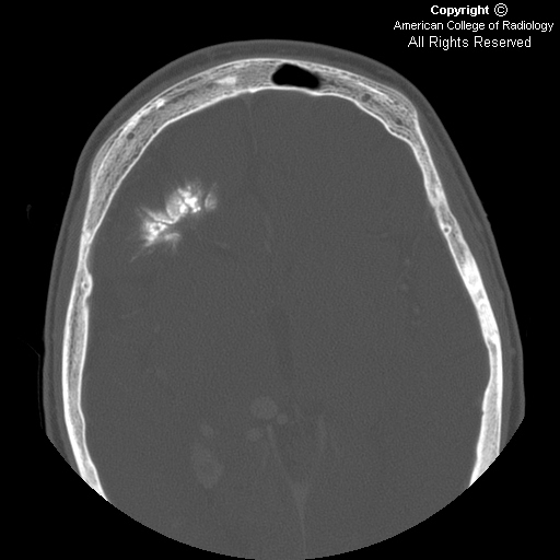 Neuroradiology On the Net SturgeWeber syndrome (SWS)